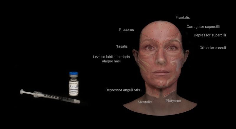 Marsha Wichers Muscles and injection points