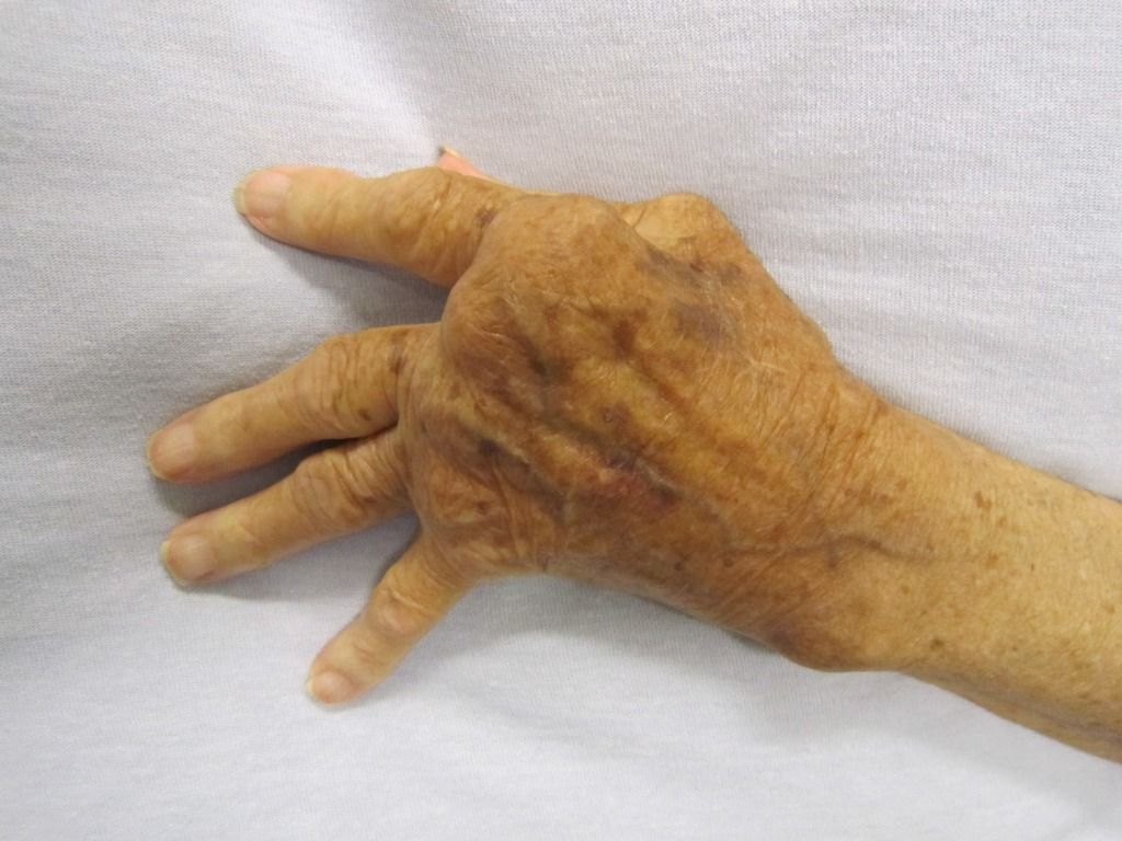 rheumatoid arthritis