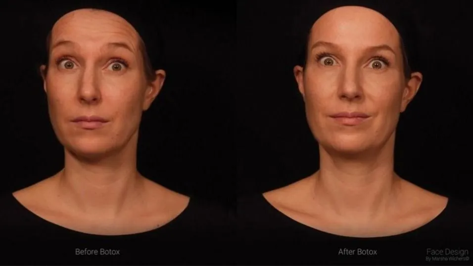 How botulinum toxin affects facial expression