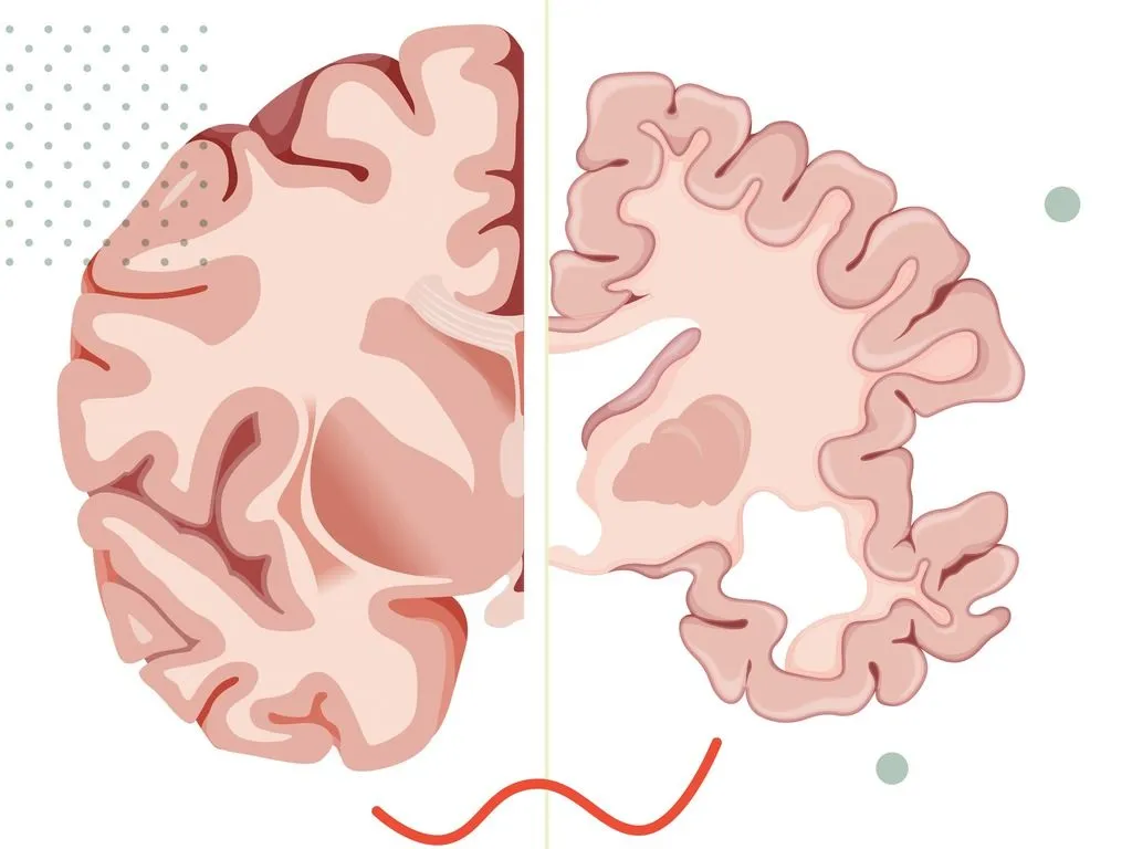 Drawing damaged Alzheimer's disease brain